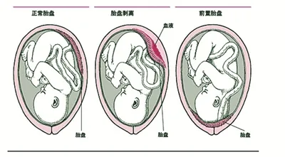 胎盘素是什么？胎盘素口服的作用是什么？胎盘素可以治绝症？