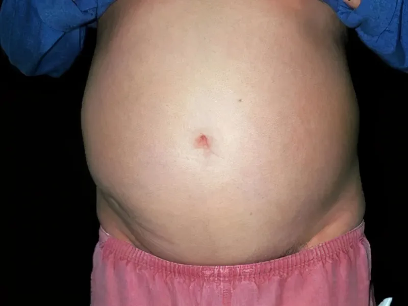 10岁男孩查出肝癌肚子如怀孕，医生说竟是因为经常吃核桃