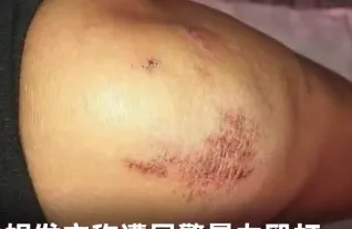 女教师绝笔信系有人帮操作 改口称记不清腿伤成因